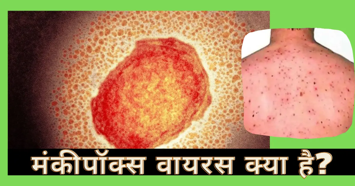 what is Monkeypox Virus